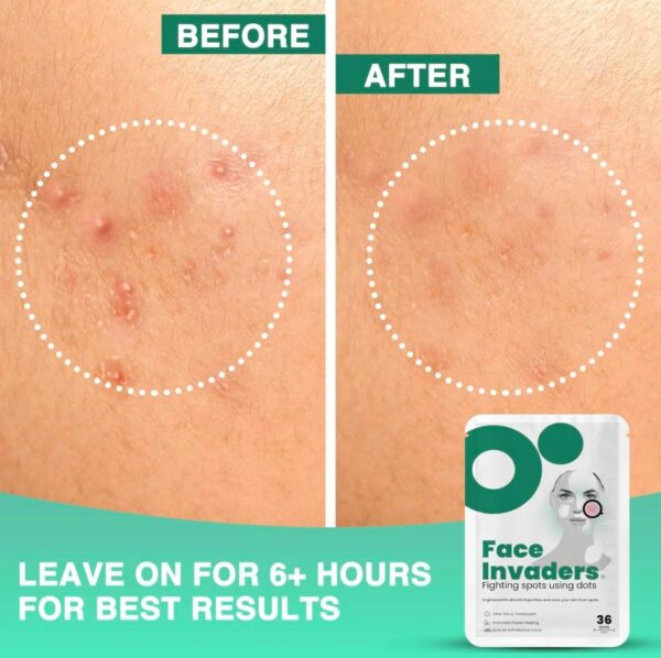 Face Invaders Acne Patches | Pack of 36 Translucent Hydrocolloid Pimple Patch Spot Treatment Stickers for Face and Body | Fast-Acting, Vegan & Cruelty Free Skin Care