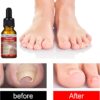 Ingrown Toenail Treatment - 30ml Ingrown Toenail - Cuticle Care Oils for Ingrown Toenails - Trimming Toenail Softening Drops Natural Ingrown Toenail Correction Treatment Fungal Nail Treatment