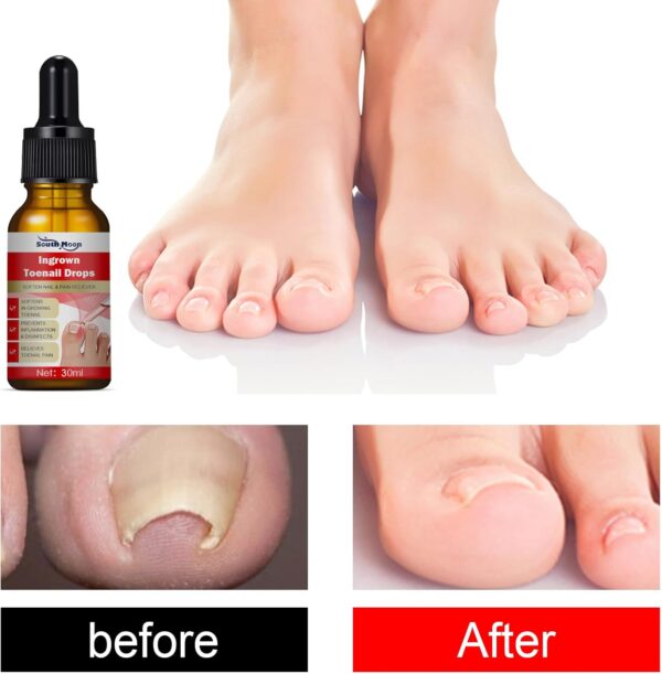 Ingrown Toenail Treatment - 30ml Ingrown Toenail - Cuticle Care Oils for Ingrown Toenails - Trimming Toenail Softening Drops Natural Ingrown Toenail Correction Treatment Fungal Nail Treatment