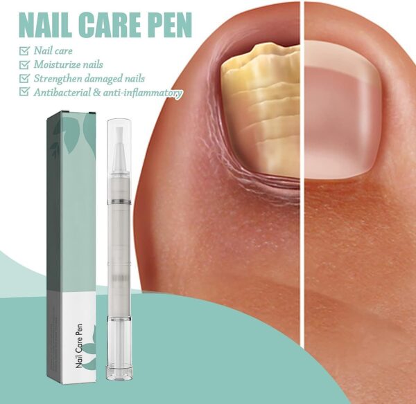 Fungal Nail Treatment Pen for Toenails and Fingernails, Toenail Fungus Treatment Pen, Fungal Nail treatment Extra Strong, Anti Fungus Nail Strengthener for Ingrown & Thick Nail Infection Treatment (1)