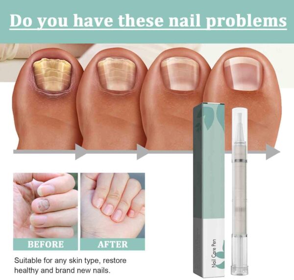 2 PCS Nail Care Pen, Nail Growth Serum, Nail Treatment Pen, Cuticle Oil For Nails, Nail Growth Treatment Pen, Nail Growth Treatment Nourishment Cuticles, Foot Care Nail Repair Pen