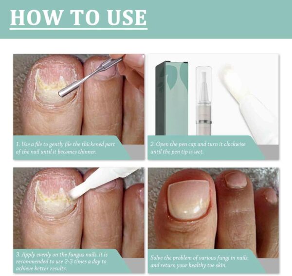 Fungal Nail Treatment Pen for Toenails and Fingernails,Fungal Nail Serum Pen,Toenail Fungus Treatment Pen,Nail Fungal Liquid,Fungal Nail Relieve,Anti Fungus Nail Repair,Improve Damaged Nails