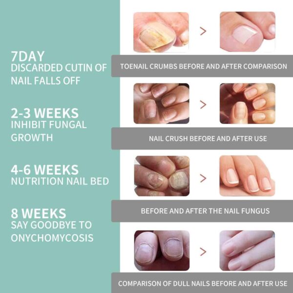 Fungal Nail Treatment Pen for Toenails and Fingernails,Fungal Nail Serum Pen,Toenail Fungus Treatment Pen,Nail Fungal Liquid,Fungal Nail Relieve,Anti Fungus Nail Repair,Improve Damaged Nails