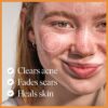 47 Skin | Hydrating Face Serum with Silver Chitoderm for ALL Skin Types | Clears Acne, Prevents & Heals Breakouts & Blemishes, Repairs Scars | Moisturises and Nourishes For Smooth Skin | 30ml