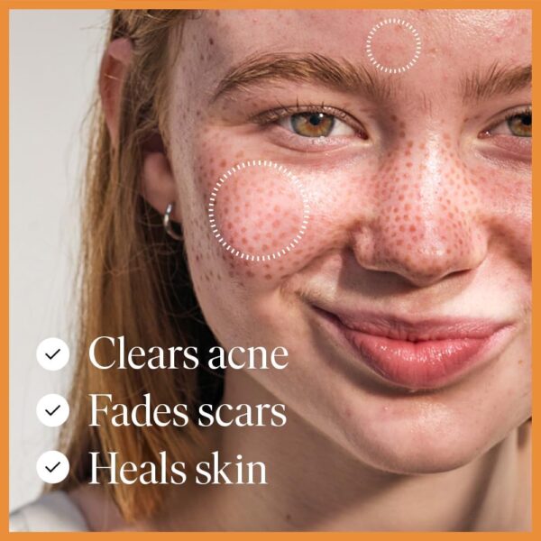 47 Skin | Hydrating Face Serum with Silver Chitoderm for ALL Skin Types | Clears Acne, Prevents & Heals Breakouts & Blemishes, Repairs Scars | Moisturises and Nourishes For Smooth Skin | 30ml