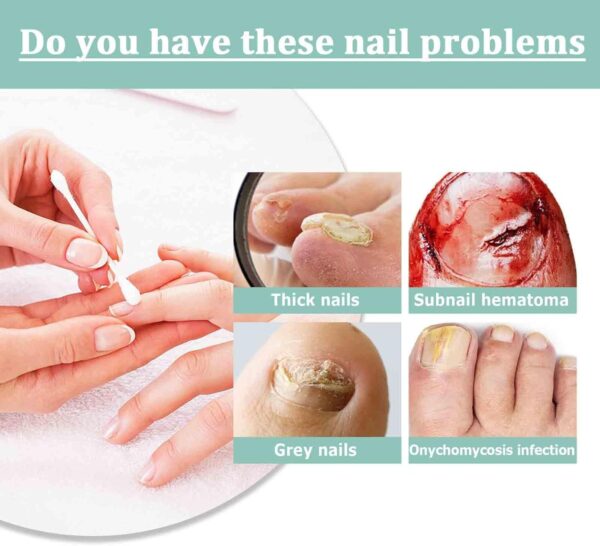 Fungal Nail Treatment Pen for Toenails and Fingernails,Fungal Nail Serum Pen,Toenail Fungus Treatment Pen,Nail Fungal Liquid,Fungal Nail Relieve,Anti Fungus Nail Repair,Improve Damaged Nails