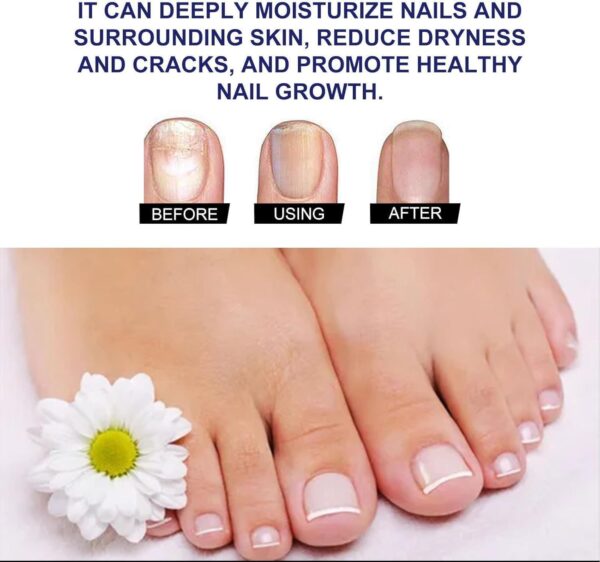 7 Days Nail Fungus Treatment Toenail Fungus Treatment Extra Strength-Ginger Nail Treatment,Toenail Cuticle Care Oil Care,Multi-Purpose Nail Repair for Your nails a Natural Shine (1)
