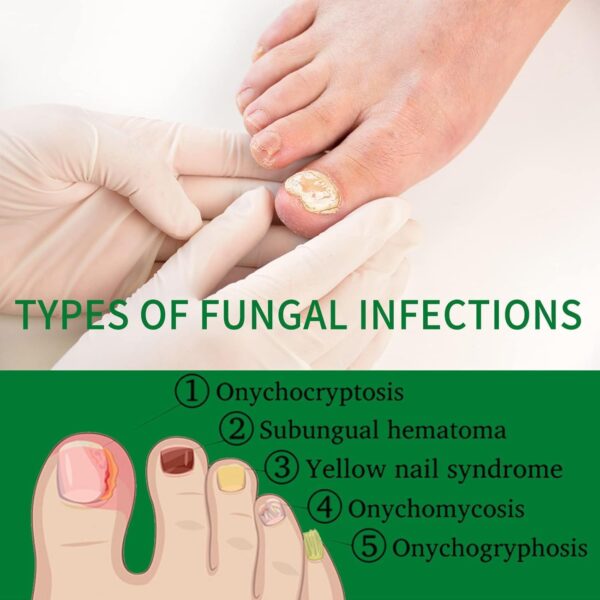 7 Days Nail Fungus Treatment Toenail Fungus Treatment Extra Strength-Ginger Nail Treatment,Toenail Cuticle Care Oil Care,Multi-Purpose Nail Repair for Your nails a Natural Shine (1)