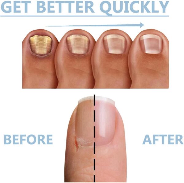 2PCS Fungal Nail Treatment Pen for Toenails and Fingernails,Nail Fungus Treatment for Toenail,Anti Fungal Nail Treatment,toe nail fungal treatment,nail repair essence,Anti Fungus Nail Strengthener
