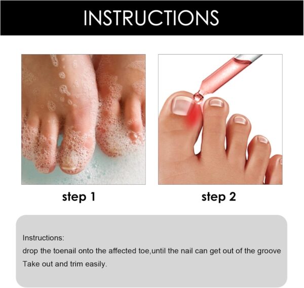 Ingrown Toenail Treatment - 30ml Ingrown Toenail - Cuticle Care Oils for Ingrown Toenails - Trimming Toenail Softening Drops Natural Ingrown Toenail Correction Treatment Fungal Nail Treatment