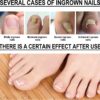 Ingrown Toenail Treatment - 30ml Ingrown Toenail - Cuticle Care Oils for Ingrown Toenails - Trimming Toenail Softening Drops Natural Ingrown Toenail Correction Treatment Fungal Nail Treatment