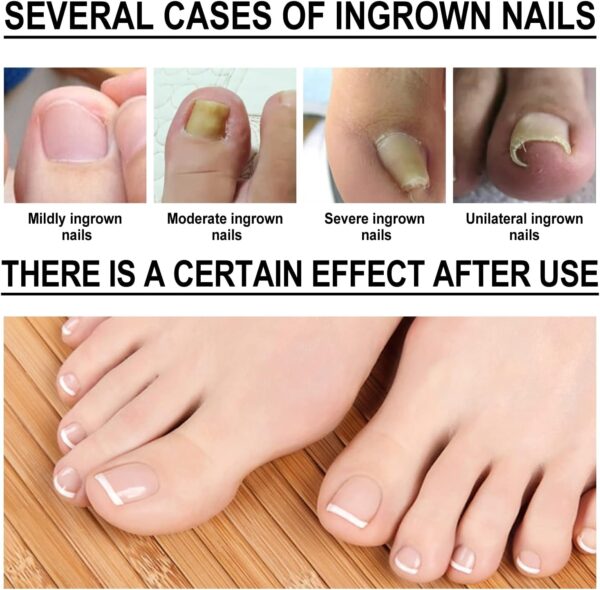 Ingrown Toenail Treatment - 30ml Ingrown Toenail - Cuticle Care Oils for Ingrown Toenails - Trimming Toenail Softening Drops Natural Ingrown Toenail Correction Treatment Fungal Nail Treatment