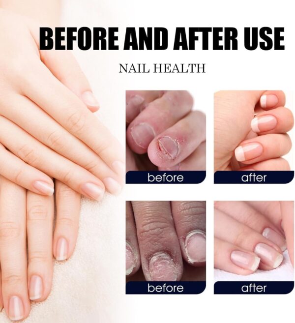 7 Days Nail Fungus Treatment Toenail Fungus Treatment Extra Strength-Ginger Nail Treatment,Toenail Cuticle Care Oil Care,Multi-Purpose Nail Repair for Your nails a Natural Shine (1)