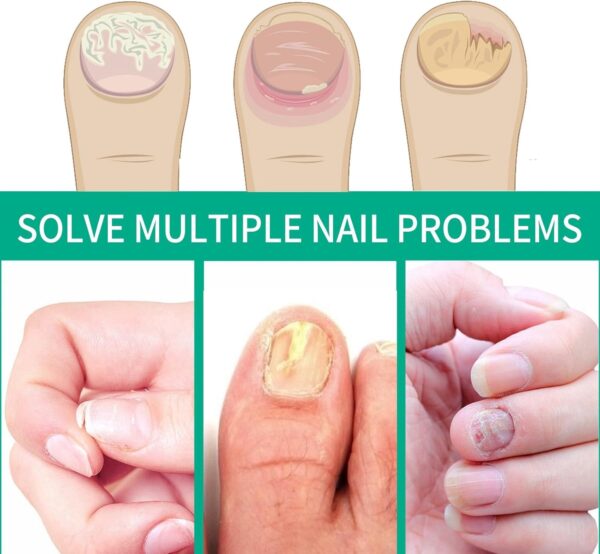 2PCS Fungal Nail Treatment Pen for Toenails and Fingernails,Nail Fungus Treatment for Toenail,Anti Fungal Nail Treatment,toe nail fungal treatment,nail repair essence,Anti Fungus Nail Strengthener