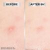 Garnier 8H Blemish Patches - Hydrocolloid patches to reduce the appearance of spots in 8H, Ultra-thin & Invisible on all skin tones - 44 Patches