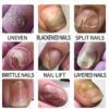 Ginger Nail Treatment Nail Support Nail Care,Fungal Nail Treatment,Ginger N/ail Growth Treatment Serum,7 D/ays Na/il Treatment,Na/il Strengthener for Damaged Nails,Nai/l Hardener,Nai/l Repair