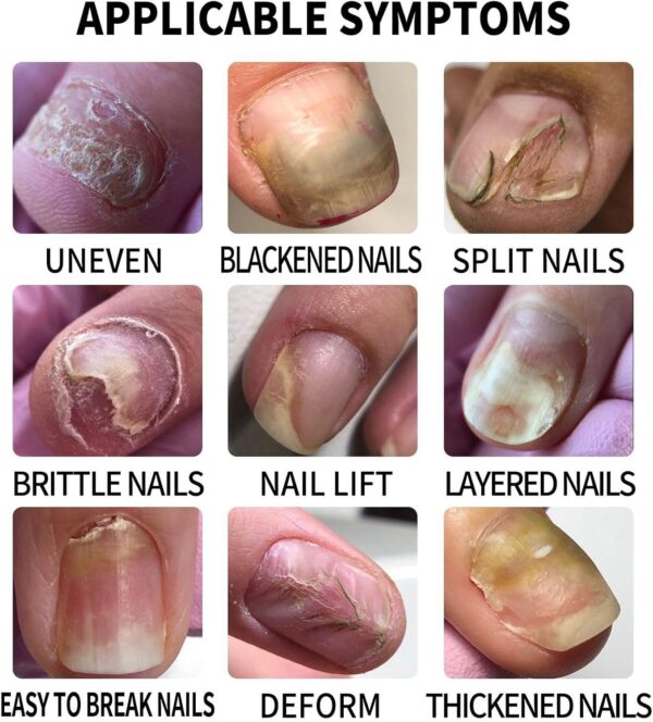 Ginger Nail Treatment Nail Support Nail Care,Fungal Nail Treatment,Ginger N/ail Growth Treatment Serum,7 D/ays Na/il Treatment,Na/il Strengthener for Damaged Nails,Nai/l Hardener,Nai/l Repair
