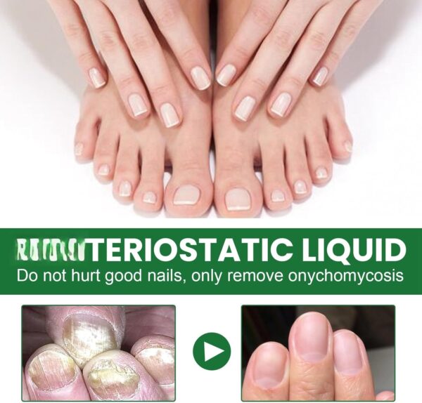 Ginger Nail Treatment Nail Support Nail Care,Fungal Nail Treatment,Ginger N/ail Growth Treatment Serum,7 D/ays Na/il Treatment,Na/il Strengthener for Damaged Nails,Nai/l Hardener,Nai/l Repair