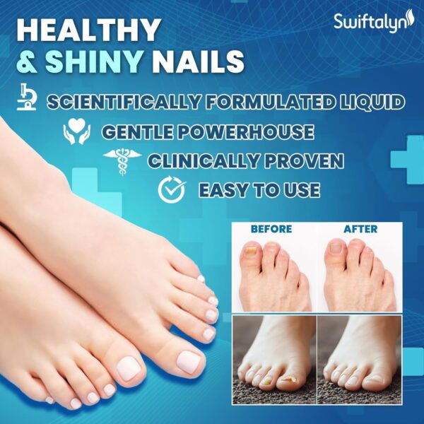 Fungal Nail Treatment for Toenalis and Fingernails: Nail Fungus Treatment for Thick, Discolored, Brittle Nails – Helps Improve Nail Appearance and Supports Healthy Growth