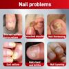 Fungal Nail Treatment Cream,Antifungal Nail Polish Cream,Nail Fungus Treatment for Toenail,Strong Anti-Fungal Toenail Cream,Nail Improve Cream,Nail Repair Cream for Thick Cracked Discolored Nails