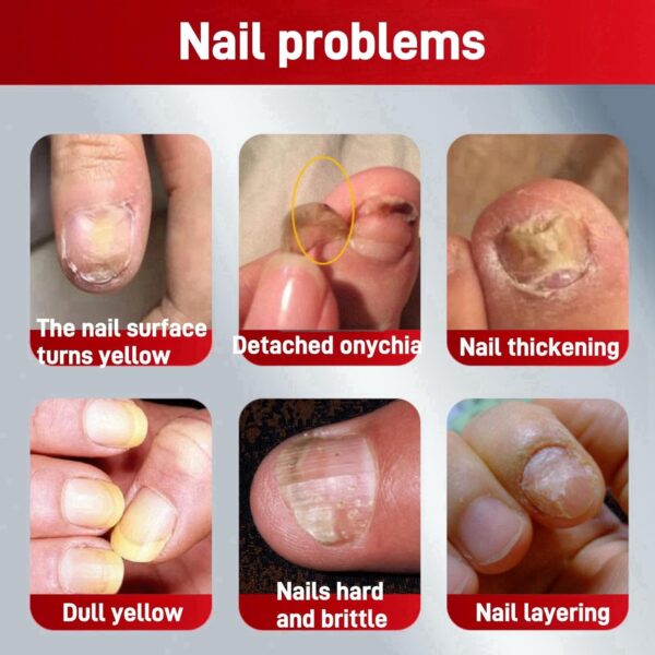 Fungal Nail Treatment Cream,Antifungal Nail Polish Cream,Nail Fungus Treatment for Toenail,Strong Anti-Fungal Toenail Cream,Nail Improve Cream,Nail Repair Cream for Thick Cracked Discolored Nails