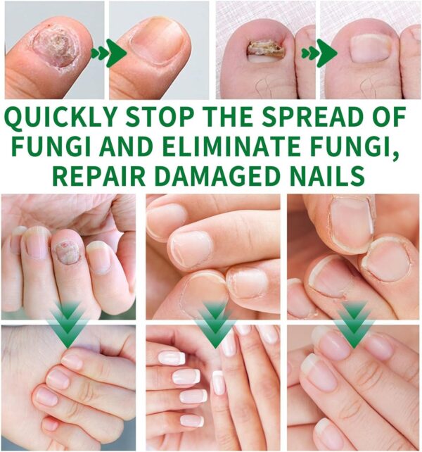 Nail Fungus Treatment, Ginger Nail Fungus Treatment,Toenail Cuticle Care Oil Care, Multi-Purpose Nail Repair for Your nails a Natural Shine (2 Pcs)