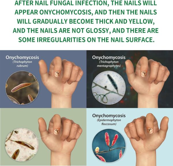 7 Days Nail Fungus Treatment Toenail Fungus Treatment Extra Strength-Ginger Nail Treatment,Toenail Cuticle Care Oil Care,Multi-Purpose Nail Repair for Your nails a Natural Shine (1)