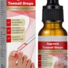 Ingrown Toenail Treatment - 30ml Ingrown Toenail - Cuticle Care Oils for Ingrown Toenails - Trimming Toenail Softening Drops Natural Ingrown Toenail Correction Treatment Fungal Nail Treatment
