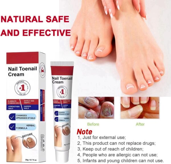 Fungal Nail Treatment Cream,Antifungal Nail Polish Cream,Nail Fungus Treatment for Toenail,Strong Anti-Fungal Toenail Cream,Nail Improve Cream,Nail Repair Cream for Thick Cracked Discolored Nails