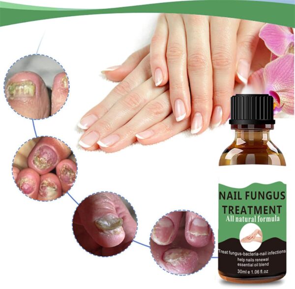 Nail Fungus Treatment For Toenail - Extra Strong Fungal Nail Treatment - Anti fungus Nail Repair and Strengthen, Fix & Renew Damaged, Broken Nails （2PC）