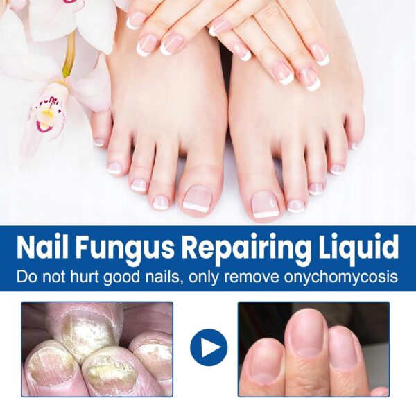 JORUN 2 Pcs Fungal Nail Treatment for Toenails Extra Strong Nail Care Serum - Natural 60 Ml Toe Nail Fungal Treatment - No Stimulation Nail Growth Treatment for Broken,Discolored Fungal Nail