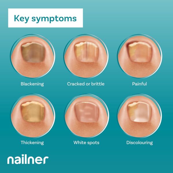 Nailner Fungal Nail Brush 5 ml - Treat & Prevent Fungal Nail Infection - Anti Fungal Nail Treatment for Toenails - Clinically proven - 300 Applications - Clear