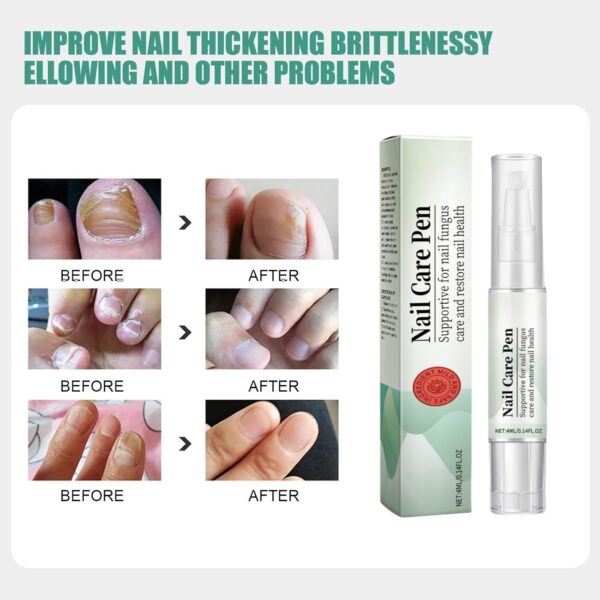 2PCS Nail Care Pen,Fungal Nail Treatment Pen,Cosmetic Care for Nail Fungus,Toenail Fungus Treatment Pen,Fungal Toenail Treatment,Antifungal Nail Polish,Nail Repair Pen for Nail