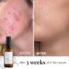 47 Skin | Hydrating Face Serum with Silver Chitoderm for ALL Skin Types | Clears Acne, Prevents & Heals Breakouts & Blemishes, Repairs Scars | Moisturises and Nourishes For Smooth Skin | 30ml