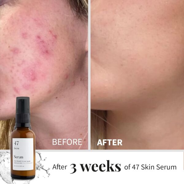 47 Skin | Hydrating Face Serum with Silver Chitoderm for ALL Skin Types | Clears Acne, Prevents & Heals Breakouts & Blemishes, Repairs Scars | Moisturises and Nourishes For Smooth Skin | 30ml