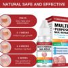 AINxtolm Fungal Nail Treatment,Nail Fungus Treatment Toenail,Toe Nail,Toenail Fungus Treatment,Fungal Nail Treatment Toenails Extra Strong,Fingernail Toenail Care Nail Repair, red, 10 millilitre
