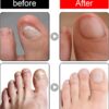 Ingrown Toenail Treatment - 30ml Ingrown Toenail - Cuticle Care Oils for Ingrown Toenails - Trimming Toenail Softening Drops Natural Ingrown Toenail Correction Treatment Fungal Nail Treatment