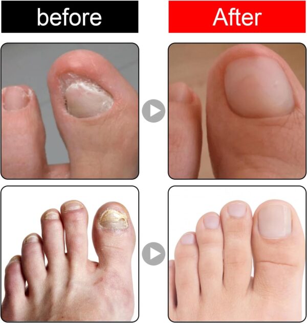 Ingrown Toenail Treatment - 30ml Ingrown Toenail - Cuticle Care Oils for Ingrown Toenails - Trimming Toenail Softening Drops Natural Ingrown Toenail Correction Treatment Fungal Nail Treatment