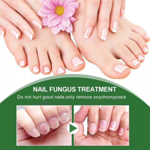 Nail Fungus Treatment For Toenail - Extra Strong Fungal Nail Treatment - Anti fungus Nail Repair and Strengthen, Fix & Renew Damaged, Broken Nails （2PC）