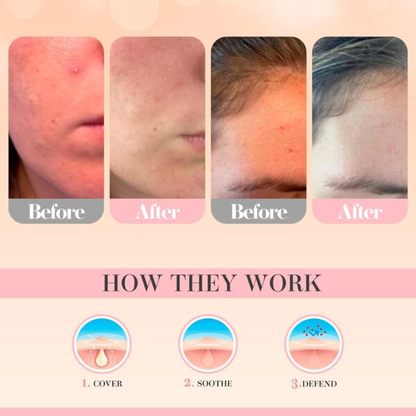 71NIw7yH66L._AC_SL1500_.jpg Pimple Patches by Glacia® – 72 Pack of Hydrocolloid Spot Patches for All Skin Types – Gentle and Natural for Clear and Smooth Skin