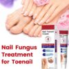 Fungal Nail Treatment Cream,Antifungal Nail Polish Cream,Nail Fungus Treatment for Toenail,Strong Anti-Fungal Toenail Cream,Nail Improve Cream,Nail Repair Cream for Thick Cracked Discolored Nails