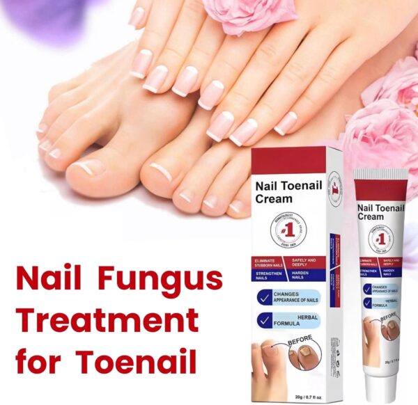 Fungal Nail Treatment Cream,Antifungal Nail Polish Cream,Nail Fungus Treatment for Toenail,Strong Anti-Fungal Toenail Cream,Nail Improve Cream,Nail Repair Cream for Thick Cracked Discolored Nails