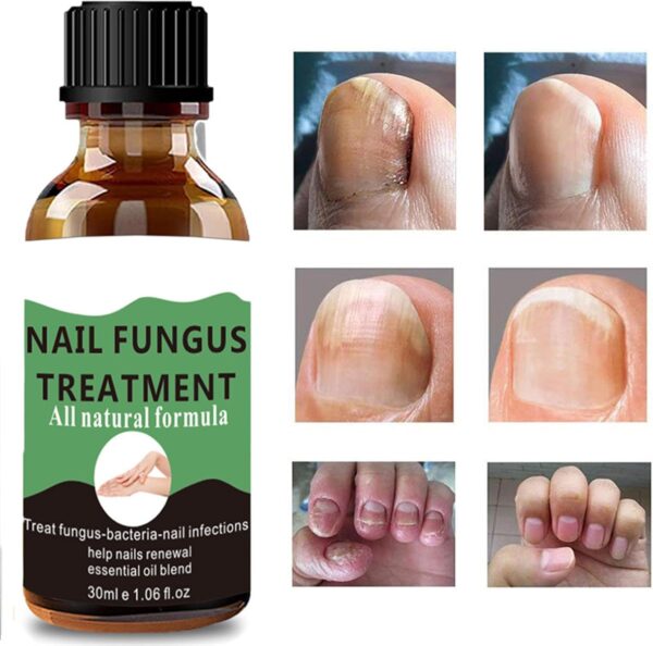 Nail Fungus Treatment For Toenail - Extra Strong Fungal Nail Treatment - Anti fungus Nail Repair and Strengthen, Fix & Renew Damaged, Broken Nails （2PC）