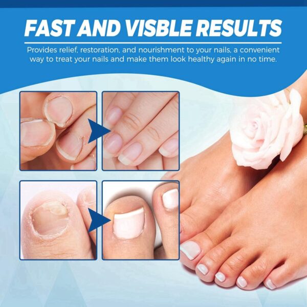 Ginger Nail Treatment Nail Support Nail Care,Fungal Nail Treatment,Ginger N/ail Growth Treatment Serum,7 D/ays Na/il Treatment,Na/il Strengthener for Damaged Nails,Nai/l Hardener,Nai/l Repair