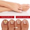 Fungal Nail Treatment Cream,Antifungal Nail Polish Cream,Nail Fungus Treatment for Toenail,Strong Anti-Fungal Toenail Cream,Nail Improve Cream,Nail Repair Cream for Thick Cracked Discolored Nails