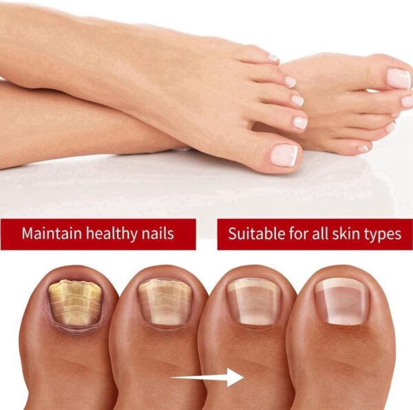 Fungal Nail Treatment Cream,Antifungal Nail Polish Cream,Nail Fungus Treatment for Toenail,Strong Anti-Fungal Toenail Cream,Nail Improve Cream,Nail Repair Cream for Thick Cracked Discolored Nails