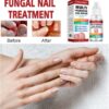 AINxtolm Fungal Nail Treatment,Nail Fungus Treatment Toenail,Toe Nail,Toenail Fungus Treatment,Fungal Nail Treatment Toenails Extra Strong,Fingernail Toenail Care Nail Repair, red, 10 millilitre