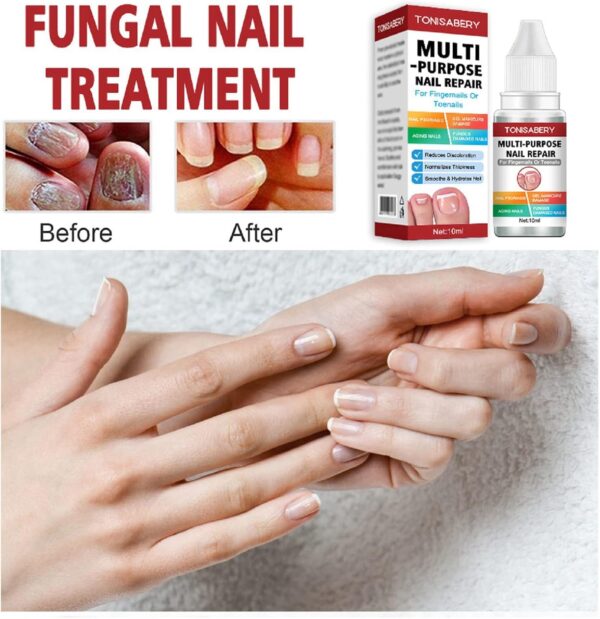 AINxtolm Fungal Nail Treatment,Nail Fungus Treatment Toenail,Toe Nail,Toenail Fungus Treatment,Fungal Nail Treatment Toenails Extra Strong,Fingernail Toenail Care Nail Repair, red, 10 millilitre