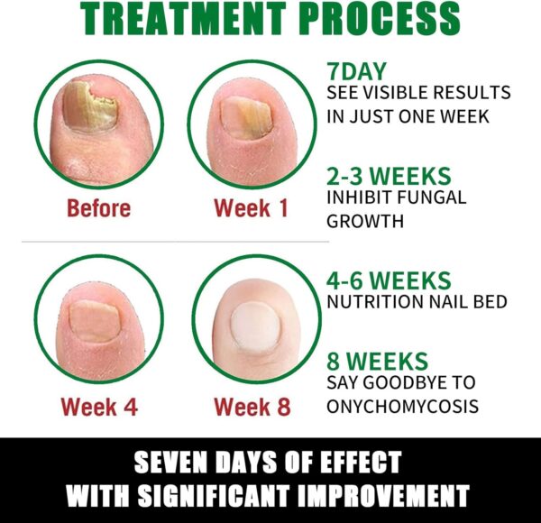 Nail Fungus Treatment, Ginger Nail Fungus Treatment,Toenail Cuticle Care Oil Care, Multi-Purpose Nail Repair for Your nails a Natural Shine (2 Pcs)