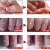 Fungal Nail Treatment Cream,Antifungal Nail Polish Cream,Nail Fungus Treatment for Toenail,Strong Anti-Fungal Toenail Cream,Nail Improve Cream,Nail Repair Cream for Thick Cracked Discolored Nails
